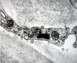 F,79y. | jejunum - amyloidosis F,79y. | jejunum - amyloidosis